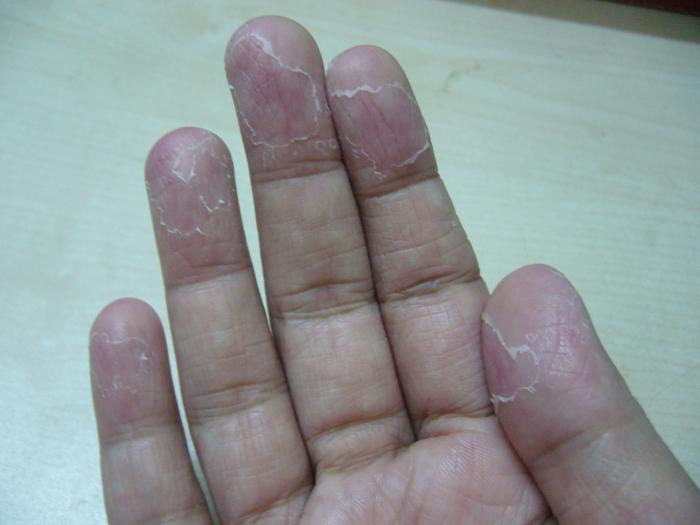 шкіра у дитини облазить шкіра на пальцях 