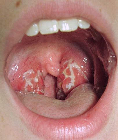 Білий наліт на язику дорослого: причини виникнення та лікування