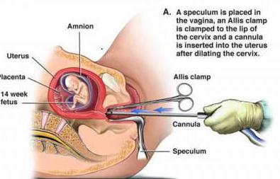 Як і де можна зробити аборт? Види медичного аборту