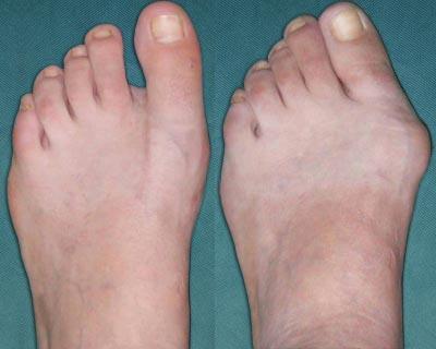 хвороби стопи ніг лікування