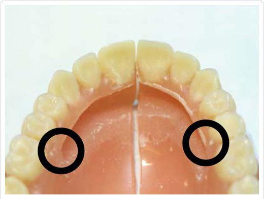 Сон сломался зубной протез. Трещина базиса протеза. Починка съемного протеза трещина. Некачественные зубные протезы. Поломка керамических протезов зубов.
