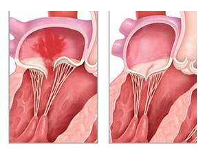 Порушення функції мітрального клапана