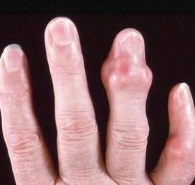 Основні симптоми ревматоїдного артриту