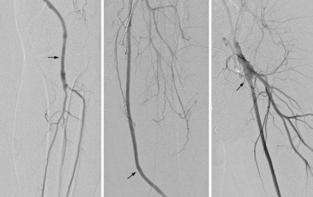 шунтування судин нижніх кінцівок ускладнення