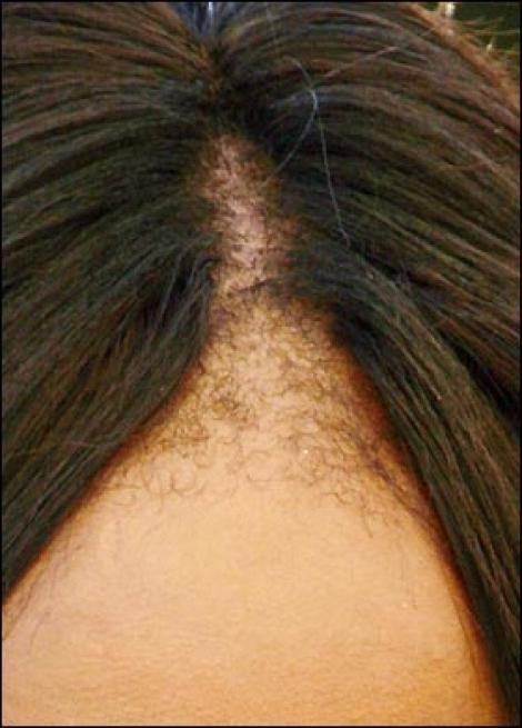 Засоби проти випадіння волосся: знайдіть і ліквідуйте причину