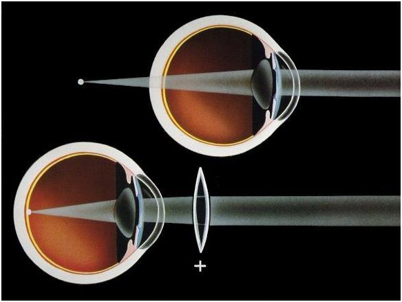 У дитини далекозорість. Причини і лікування